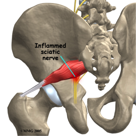 Is It Really SCIATICA? — Indy Spine and Rehab