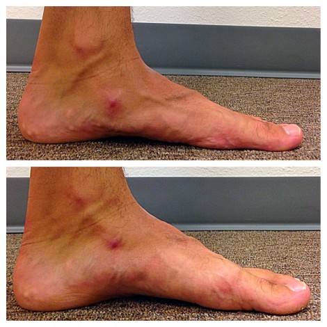 foot posture collapsed arch