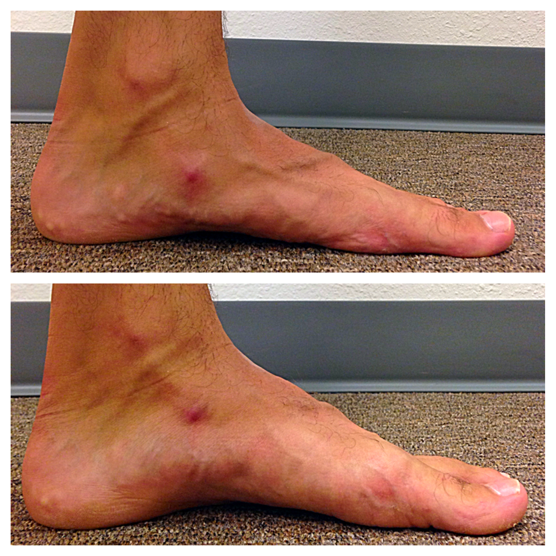 foot arch pain after running